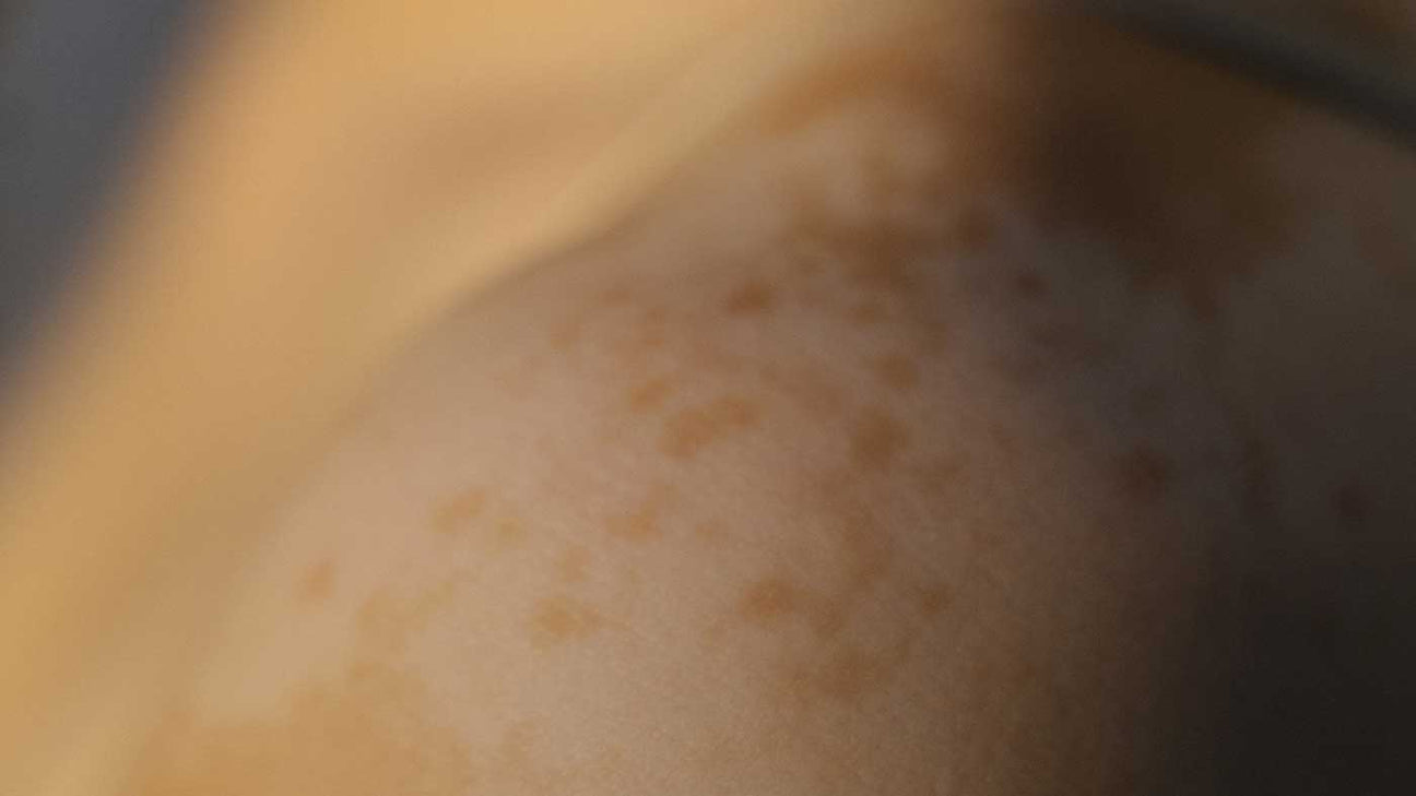 Skin Discoloration Causes & Treatments
