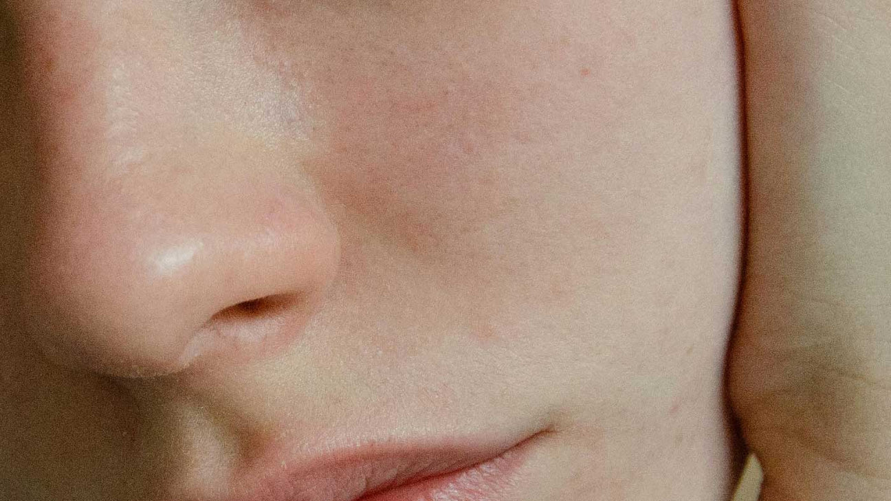 Sensitive Skin: Causes, Symptoms & Recommended Treatment