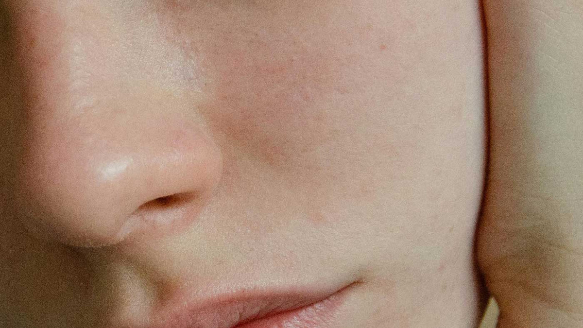 Sensitive Skin: Causes, Symptoms & Recommended Treatment