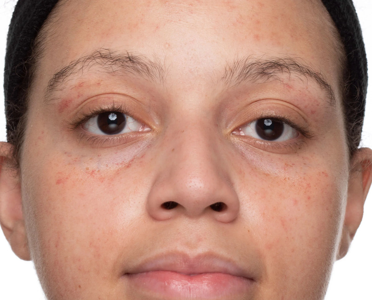 Before -  - Compare