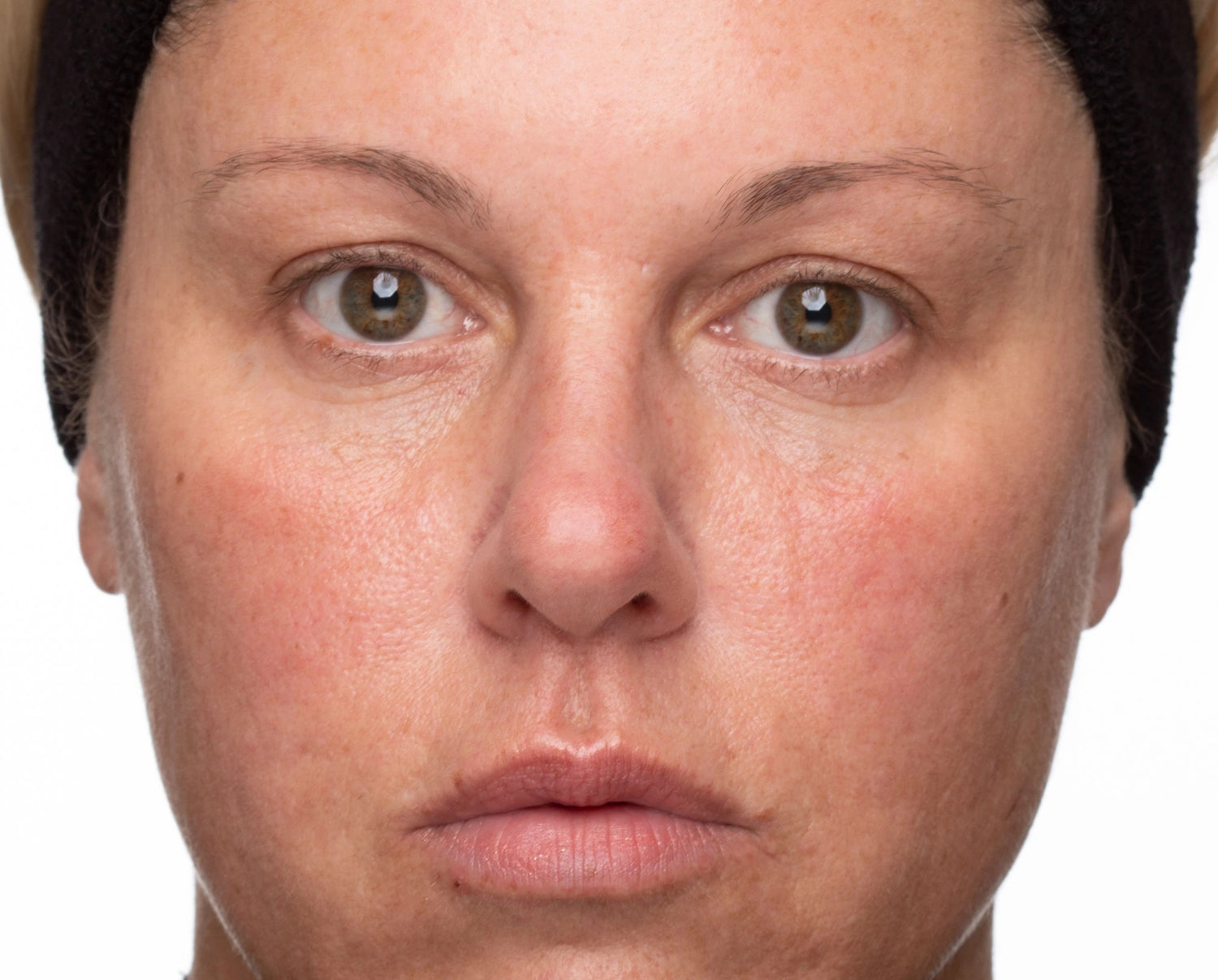 Before -  - Compare
